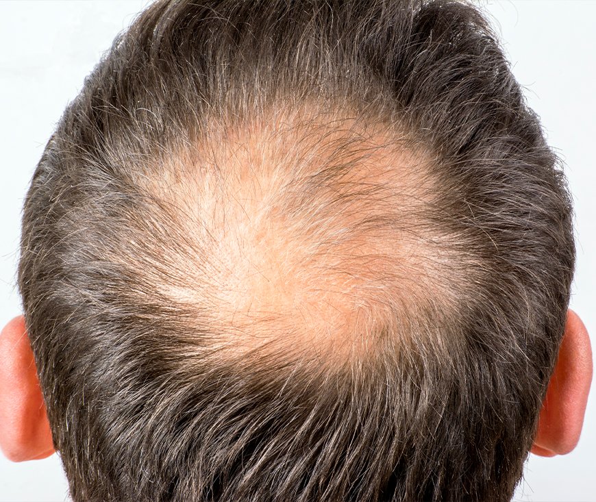 Traitements contre la Perte de Cheveux